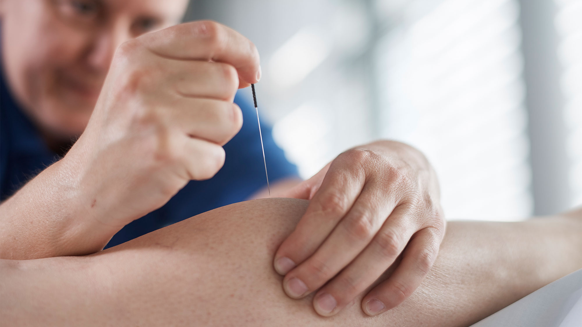 Dry Needling